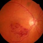 Retinal Hemorrhages Close Up